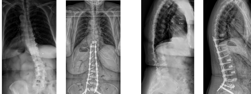 xrays showing spine before and after surgery for deformity