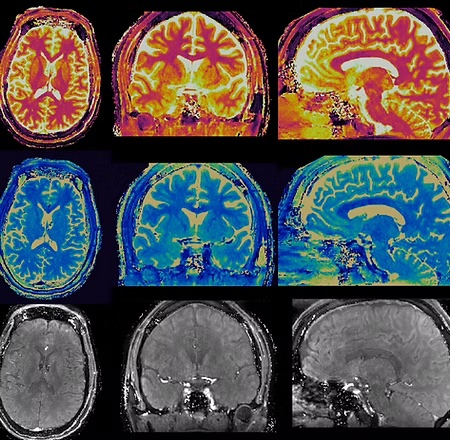 Brain imaging
