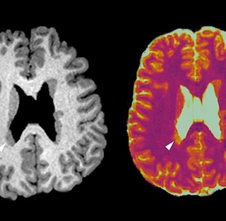 Brain imaging