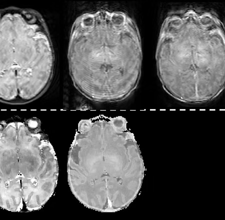 Brain imaging
