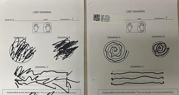 A comparison of handwriting before and after HIFU